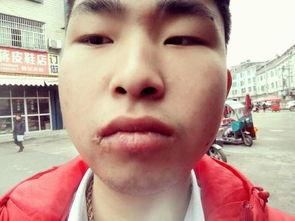 吃瓜嘴角疼,嘴角疼的尴尬日常